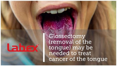 glossectomy of tongue.